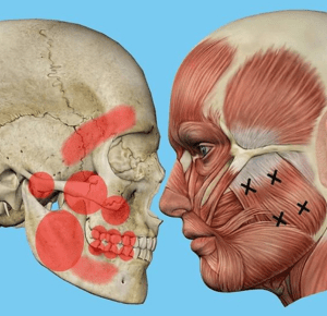 Temporomandibular Joint Dysfunction Pain - 25 Key Points