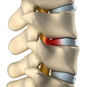 Disc Bulge, Disc Bulge Treatment