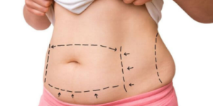 Tummy Tuck Surgeon In Bangalore