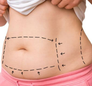 Tummy Tuck Surgeon In Bangalore